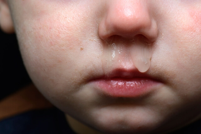 KLART, VANDIG SNØRR: Tegn på lett virus-forkjølelse eller allergier. Foto: NTB scanpix KLART, VANDIG SNØRR: Tegn på lett virus-forkjølelse eller allergier. Foto: NTB scanpix